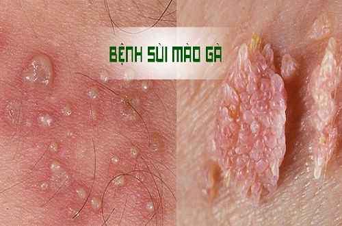 Hình ảnh những nốt mụn sùi mào gà