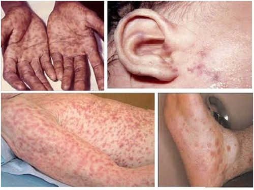 phân biệt biểu hiện bệnh lậu và giang mai