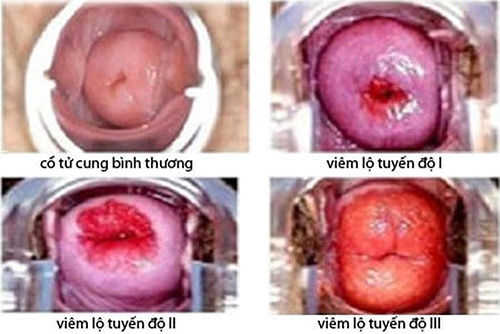 các bệnh phụ khoa nguy hiểm 1 các bệnh phụ khoa nguy hiểm 1