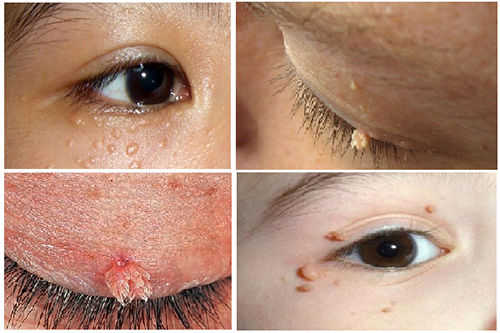 biểu hiện sùi mào gà ở mắt biểu hiện sùi mào gà ở mắt