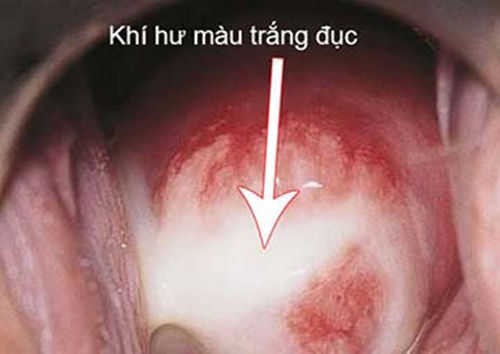 ra khí hư màu trắng đục và ngứa