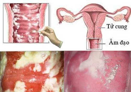 khí hư màu trắng đục và vón cục như bã đậu khí hư màu trắng đục và vón cục như bã đậu