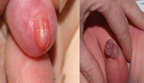 Biêu hiện trẻ nhỏ bị viêm nhiễm ở bao quy đầu