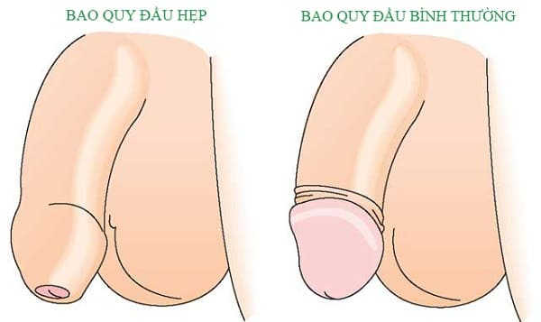 Nguyên nhân viêm bao quy đầu là gì