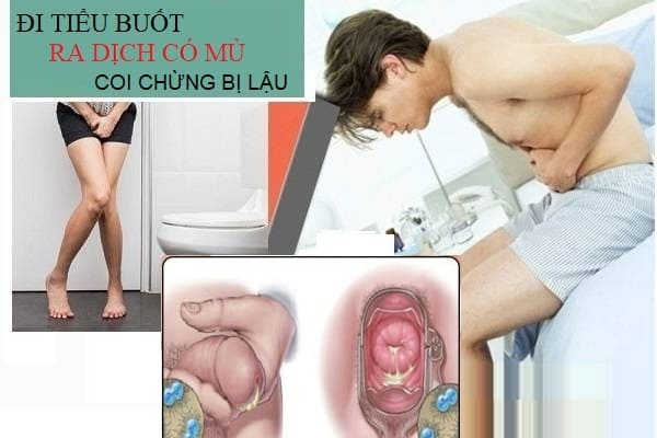 Đi tiểu buốt ra dịch mủ có phải bệnh lậu không