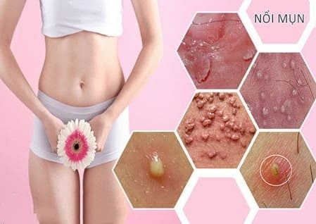 mọc mụn ở mép vùng kín phải làm sao