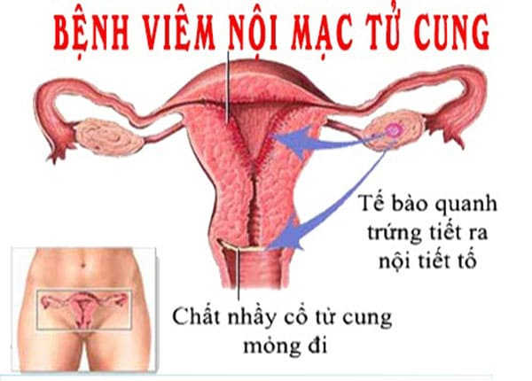 nguyên nhân tiểu buốt ở nữ giới