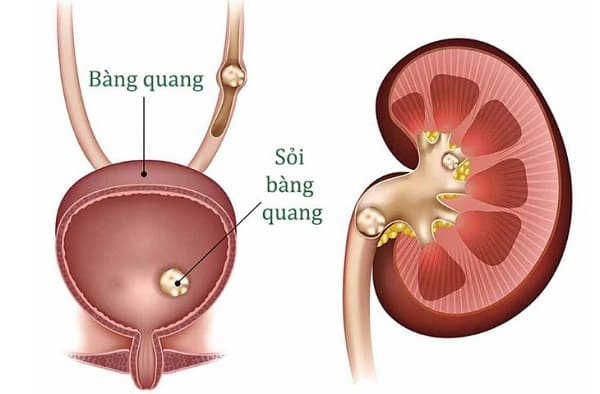 nguyên nhân tiểu buốt ra dịch mủ là gì