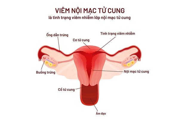 nguyên nhân tiểu buốt ra dịch mủ 2