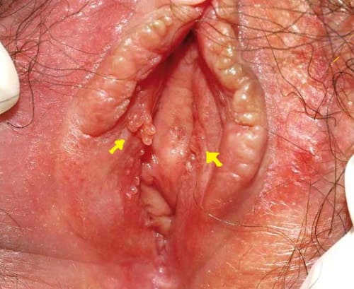 Nổi mụn ở vùng kín 2