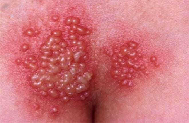 nổi mụn ở vùng kín do bệnh mụn rộp