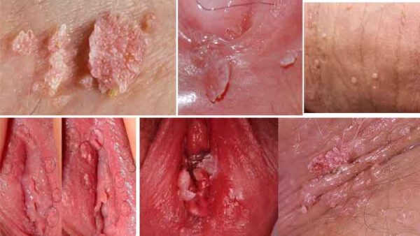 Nổi mụn ở vùng kín sùi mào gà