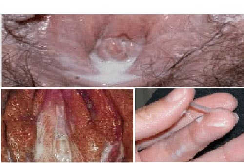Tiểu buốt ra dịch mủ có thể là do bệnh lậu