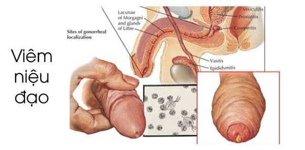 Tiểu buốt ra dịch mủ là bệnh gì