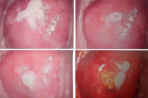 triệu chứng tiểu buốt do bệnh lậu