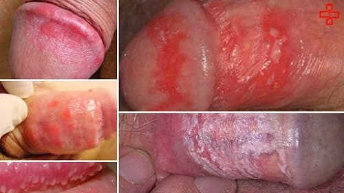 viêm da bao quy đầu là như thế nào