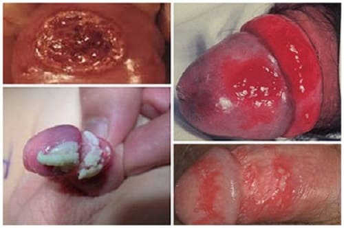 viêm bao quy đầu nặng