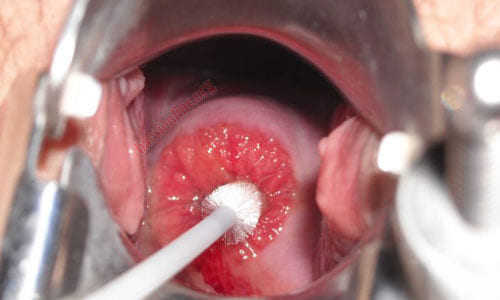 Ngứa âm đạo là bệnh gì