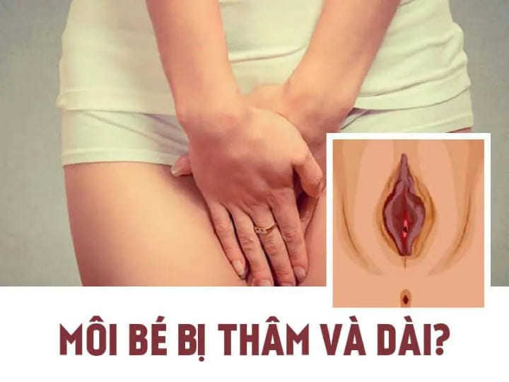 âm đạo bị thâm đen sau khi sinh