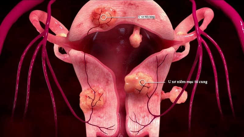 ảnh hưởng của u xơ tử cung
