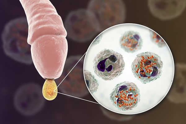 viêm bao quy đầu có dịch mủ gây bệnh