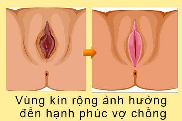 se khít âm đạo sau sinh