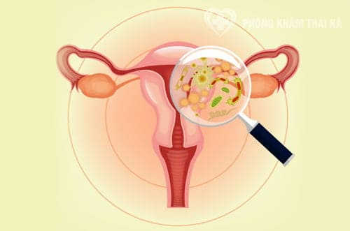 Viêm nhiễm âm đạo sau sinh