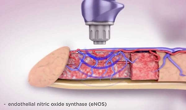 Điều trị rối loạn cương dương