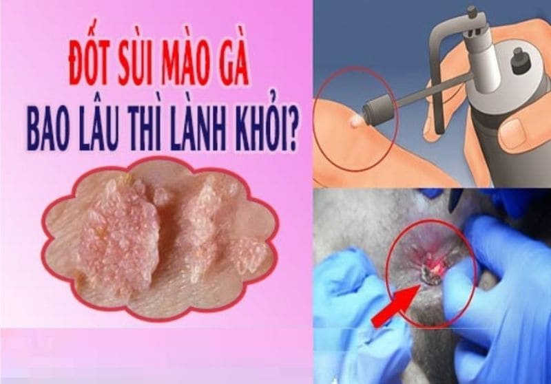 Đốt sùi mào gà bao lâu thì khỏi?
