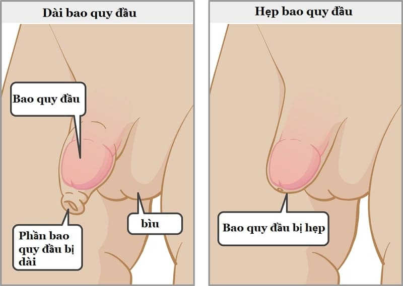 hẹp bao quy đầu ở trẻ là như thế nào điều trị ra sao