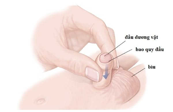 hướng dẫn nong bao quy đầu cho trẻ em