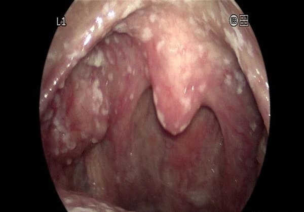 nhiễm nấm Candida ở thực quản họng