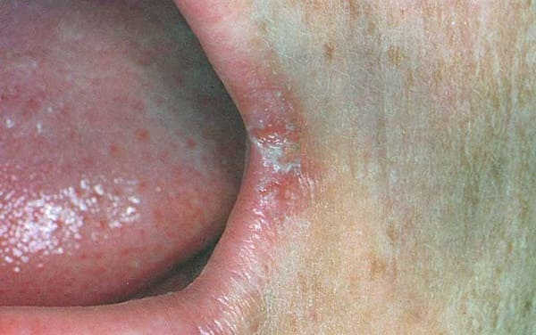 nhiễm nấm Candida ở miệng