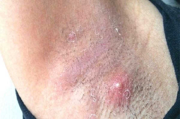 nhiễm nấm candida ở nách
