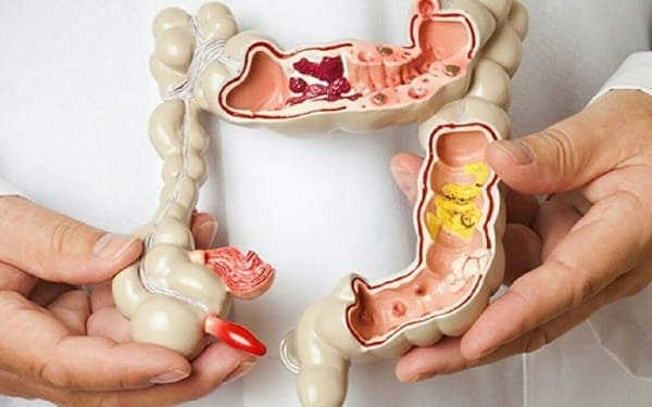 Polyp đại tràng là gì