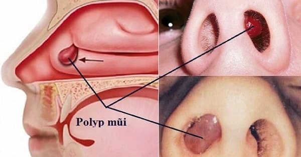 Polyp mũi là gì