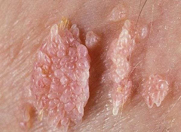 Sùi mào gà triệu chứng nguyên nhân và cách chữa