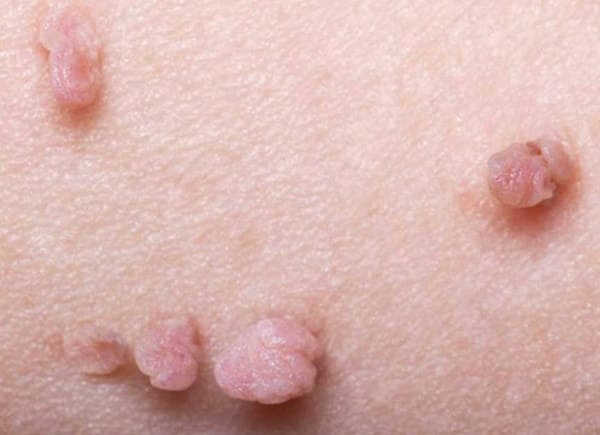 sùi mào gà giai đoạn phát triển bệnh