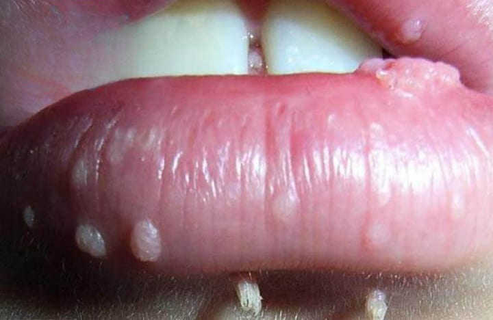 sùi mào gà ở miệng