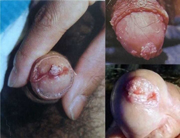 sùi mào gà ở dương vật nam giới