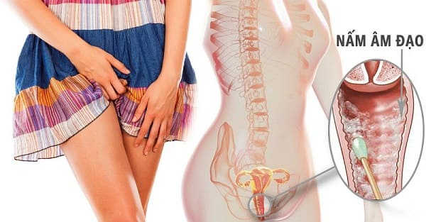 triệu chứng nấm candida là gì