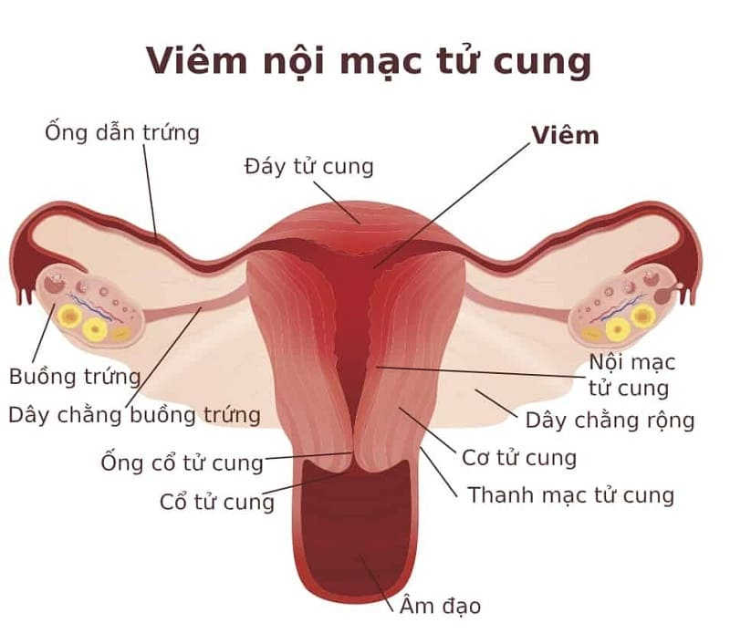 viêm nội mạc tử cung là gì