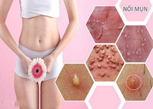 Vùng kín bị ngứa và nổi hạt là gì