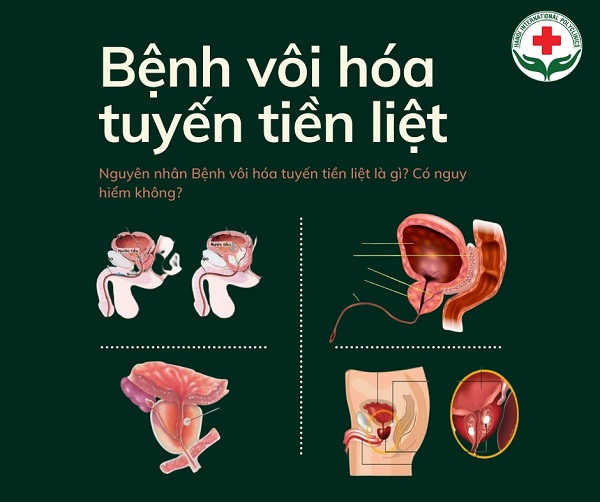 benh-voi-hoa-tien-liet-tuyen