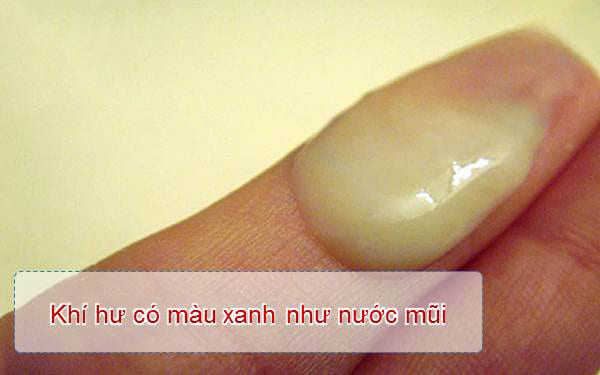 khí hư màu xanh là gì