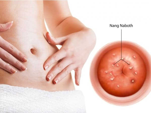 nang Naboth cổ tử cung là gì