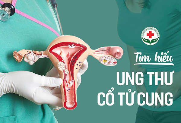 ung thư cổ tử cung