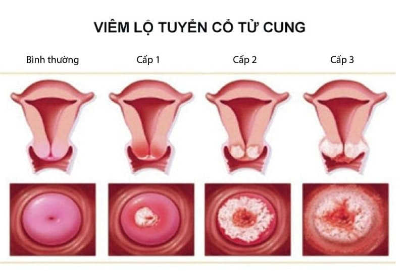 Viêm cổ tử cung là gì
