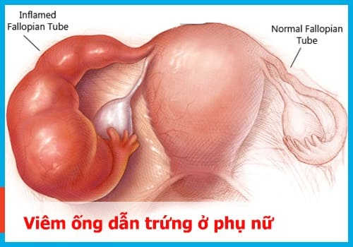 viêm ống dẫn trứng phải làm sao