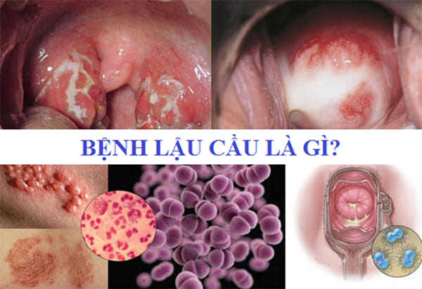 chữa bệnh lậu bao lâu thì khỏi 2